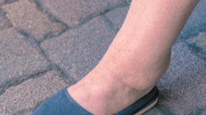 6 Causes of Water Retention and How to Reverse It