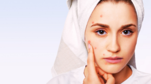 How to Remove Blackheads Naturally